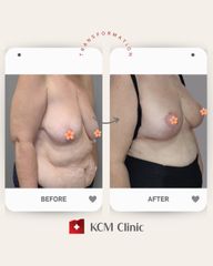 Mastopeksja - KCM Clinic Chirurgia Plastyczna i Bariatria