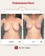 Mastopeksja - KCM Clinic Chirurgia Plastyczna i Bariatria