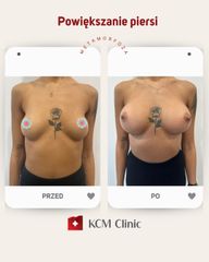 Powiększanie biustu - KCM Clinic Chirurgia Plastyczna i Bariatria