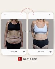 Plastyka brzucha - KCM Clinic Chirurgia Plastyczna i Bariatria