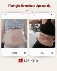 Plastyka brzucha - KCM Clinic Chirurgia Plastyczna i Bariatria