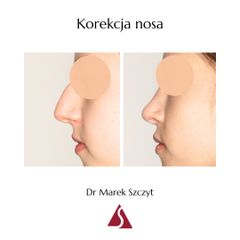 Korekta nosa - Dr Marek Szczyt
