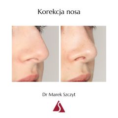 Korekta nosa - Dr Marek Szczyt