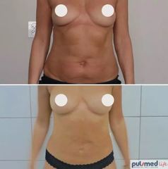 lipofilling_2