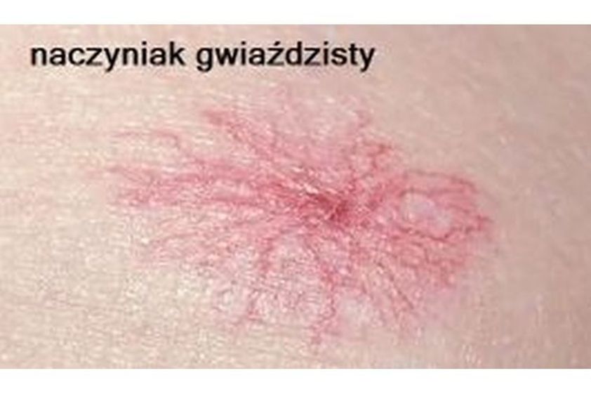 Naczyniaki przed i po - 692444