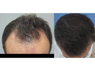Przed i po - Przeszczep włosów FUE
