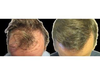 Przed i po - Przeszczep włosów