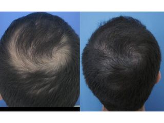 Przed i po - Przeszczep włosów