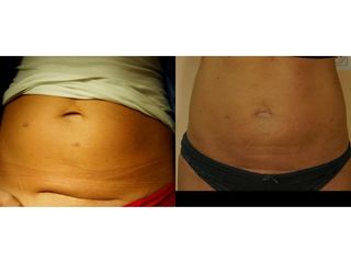 Przed i po - liposukcja połączona z lipolizą laserową