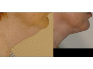 Przed i po - Liposukcja podbródka