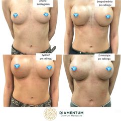 Powiększanie biustu - Klinika Diamentum