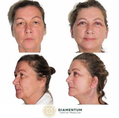Lifting twarzy - Klinika Diamentum