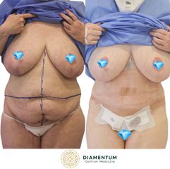 Plastyka brzucha - Klinika Diamentum