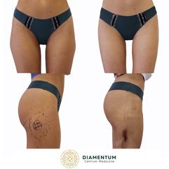 Liposukcja - Klinika Diamentum