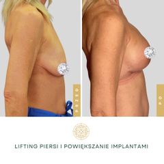 Lifting piersi i powiększenie implantami - Klinika Diamentum