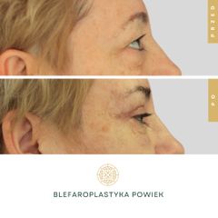 Blefaroplastyka - Klinika Diamentum