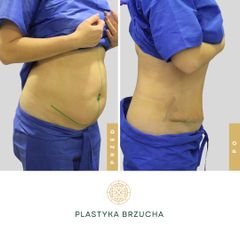 Plastyka brzucha - Klinika Diamentum