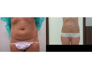 Abdominoplastyka - przed i po