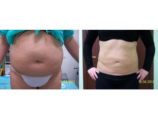 Liposukcja brzucha - przed i po