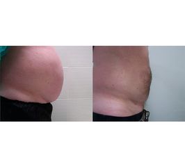 Liposukcja - Centrum Liposukcji