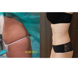 Liposukcja - Centrum Liposukcji