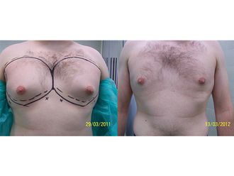 Liposukcja ultradźwiękowa przed i po - 791523
