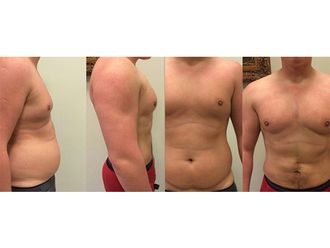 Liposukcja ultradźwiękowa przed i po - 791527