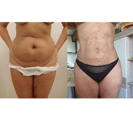 Liposukcja - Centrum Liposukcji
