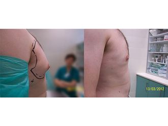 Liposukcja ultradźwiękowa przed i po - 791529