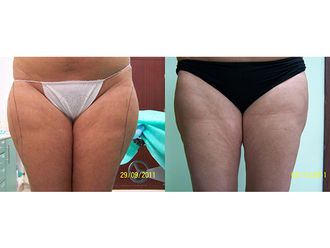 Liposukcja ultradźwiękowa przed i po - 791530