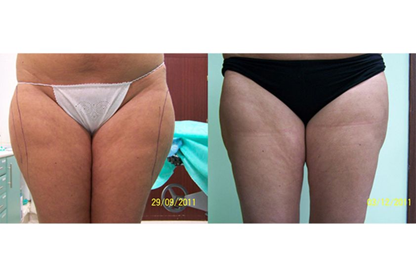 Liposukcja ultradźwiękowa przed i po - 791530