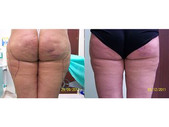 Liposukcja ultradźwiękowa przed i po - 791531