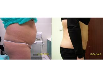 Liposukcja ultradźwiękowa przed i po - 791532
