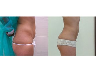 Liposukcja ultradźwiękowa przed i po - 791533