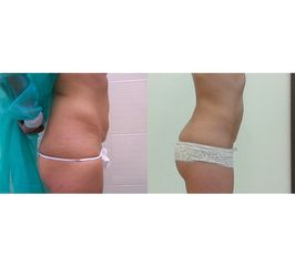 Liposukcja - Centrum Liposukcji