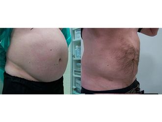 Liposukcja ultradźwiękowa przed i po - 791534