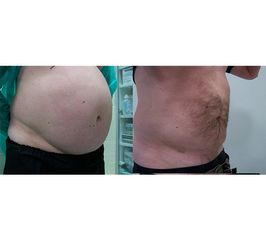 Liposukcja - Centrum Liposukcji