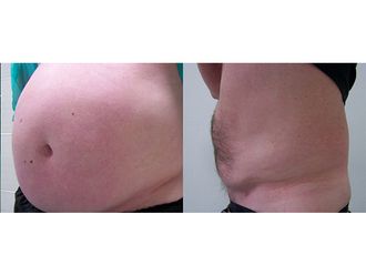 Liposukcja ultradźwiękowa przed i po - 791535