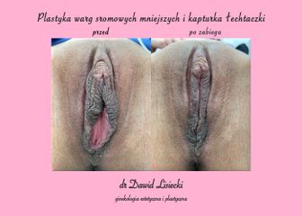 Labioplastyka - lek. Dawid Lisiecki