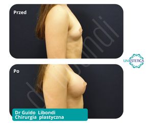 Powiększanie piersi - przed  po
