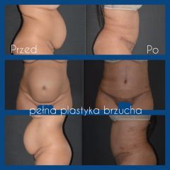 Plastyka brzucha - przed i po