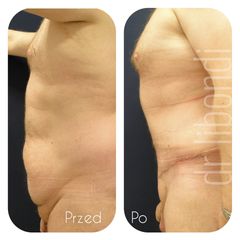 Plastyka brzucha męska z liposukcją - przed i po