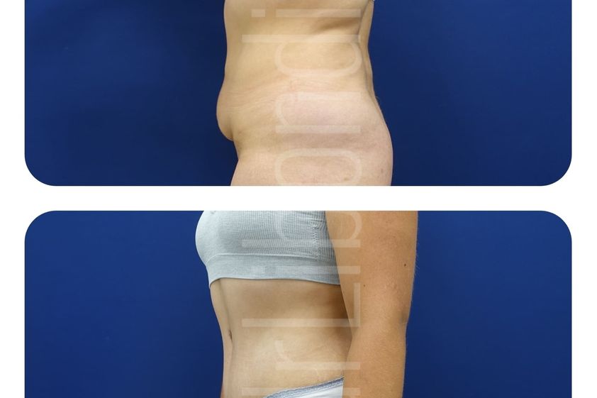 Liposukcja przed i po - 807927