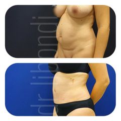 Plastyka brzucha - UniEstetica