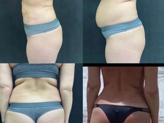 Liposukcja przed i po - 839036