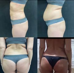 Liposukcja - Klinika SaskaMed dr Rafał Kuźlik