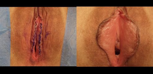 Labioplastyka - Klinika SaskaMed dr Rafał Kuźlik