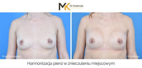 Harmonizacja piersi