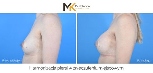 Harmonizacja piersi