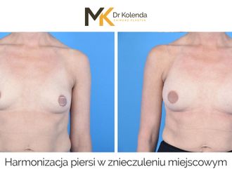 Powiększanie biustu przed i po - 874943